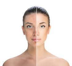 🌸 How to Remove Pigmentation According to Skin Type